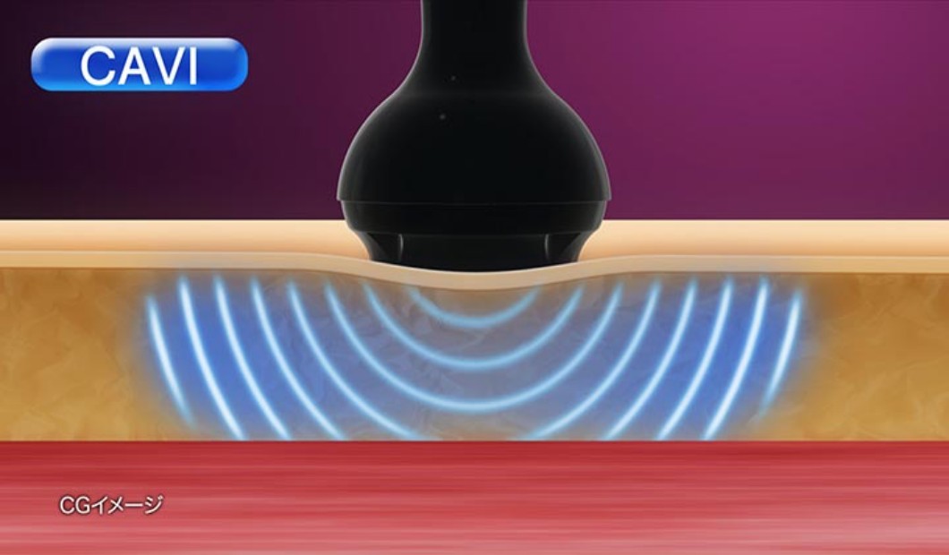 業務用ボディトリートメントマシン【キャビスパ for Pro プレミア 