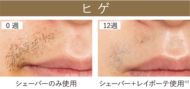 ヒゲ 0週 シェーバーのみ使用 12週 シェーバー＋レイボーテ使用