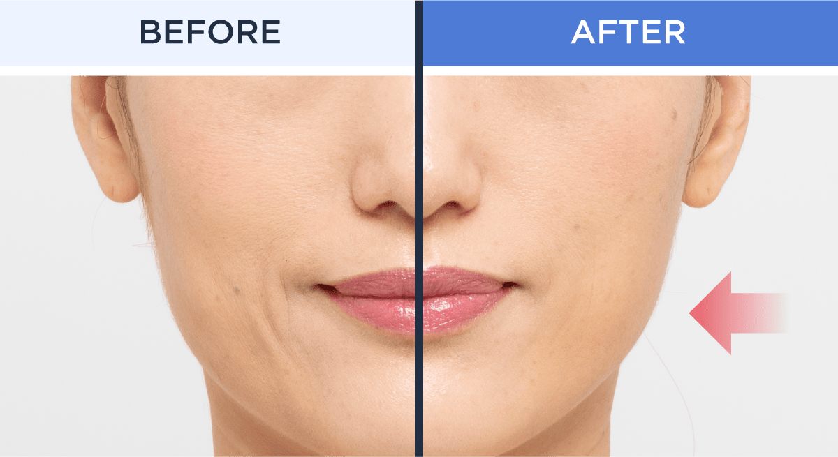 BEFORE AFTER