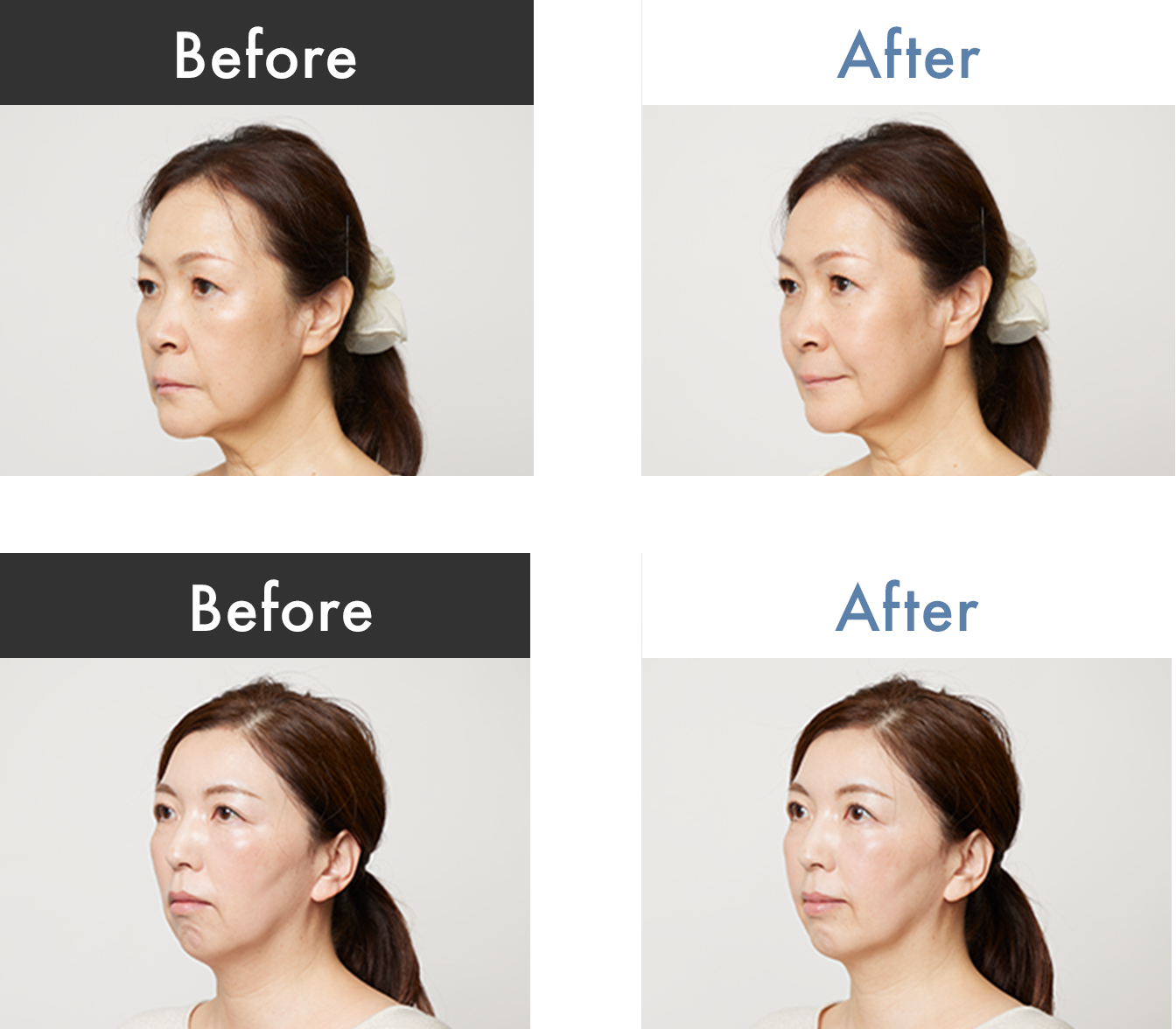 before after